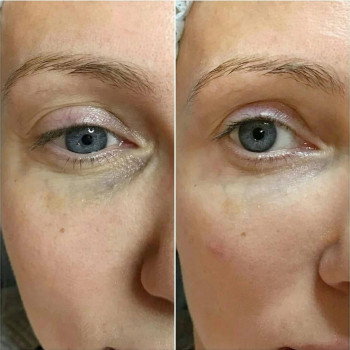 Біоревіталізація зони навколо очей до/після