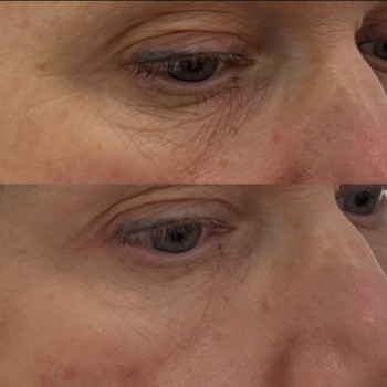 Біоревіталізація зони навколо очей до/після