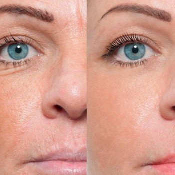 Біоревіталізація обличчя до/після