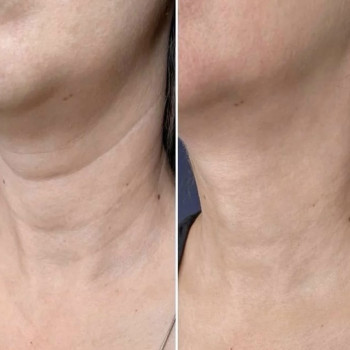 Біоревіталізація шиї до/після