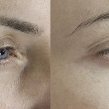 Біоревіталізація зони навколо очей до/після