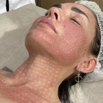 Біоревіталізація обличчя, шиї, декольте