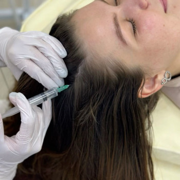 Біоревіталізація при випадінні волосся