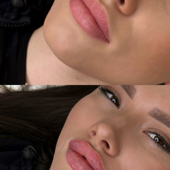 Контурна пластика губ