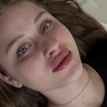 Контурна пластика губ