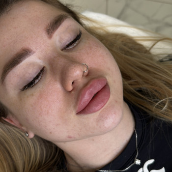 Контурна пластика губ