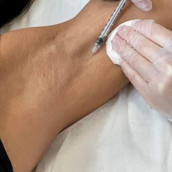 Гіпергідроз — стан, при якому потові залози працюють надмірно активно. Найчастіше підвищене потовиді...