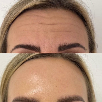 Ботулінотерапія зона чоло + міжбрівʼя до/після