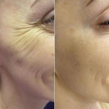 Ботулінотерапія до/після