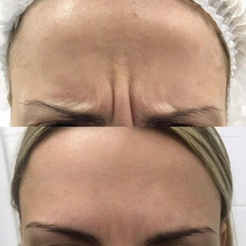 Ботулінотерапія міжбрівʼя до/після