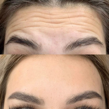 Ботулінотерапія зона чоло + міжбрівʼя до/після