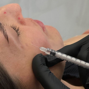 Ботулінотерапія