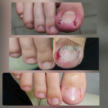 Врослий ніготь, лікування / лечение вросшего ногтя