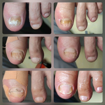 грибок ногтей