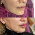 Збільшення губ! Дерматолог косметолог Нелли Київ