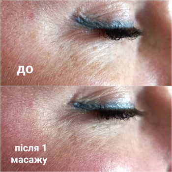 Іспанський масаж, після 1 сеансу
