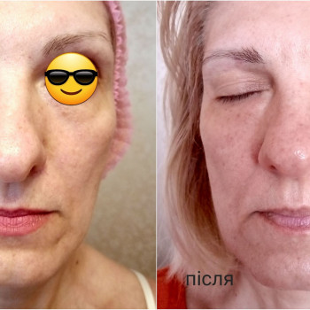 Міофасціальний масаж