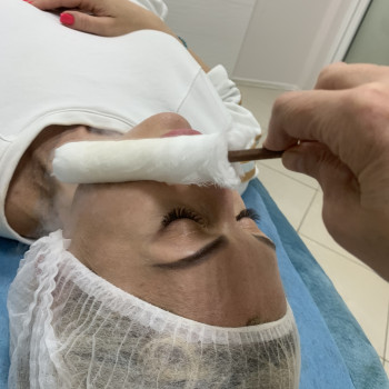 Криотерапия лица