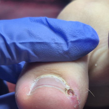 Обробка врослого нігтя
                    Салон красоты OH NAILS Одесса