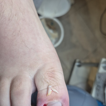 Обробка врослого нігтя
                    Салон красоты OH NAILS Одесса