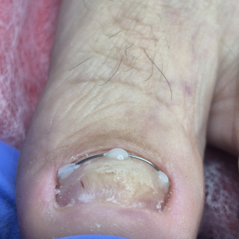 Обробка врослого нігтя
                    Салон красоты OH NAILS Одесса