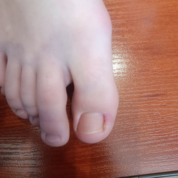 Обробка врослого нігтя
                    Салон красоты OH NAILS Одесса