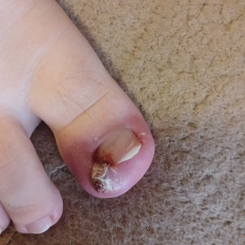 Обробка врослого нігтя
                    Салон красоты OH NAILS Одесса