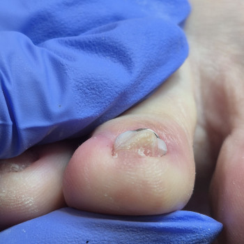 Обробка врослого нігтя
                    Салон красоты OH NAILS Одесса