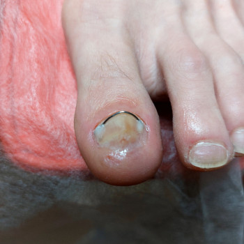 Лікування нігтів
                    Салон краси OH NAILS Одеса