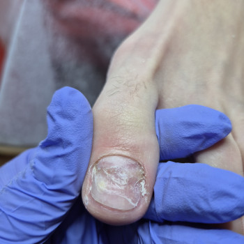 Лікування нігтів
                    Салон краси OH NAILS Одеса