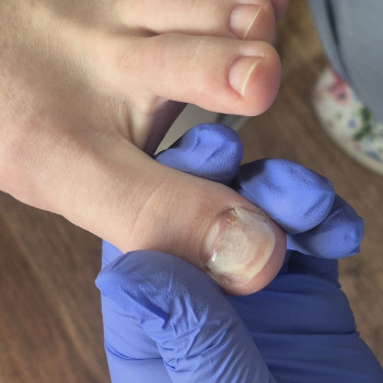 Лікування нігтів
                    Салон краси OH NAILS Одеса