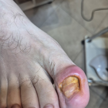 Лікування нігтів
                    Салон краси OH NAILS Одеса