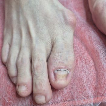 Лікування нігтів
                    Салон краси OH NAILS Одеса