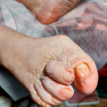 Лікування нігтів
                    Салон краси OH NAILS Одеса