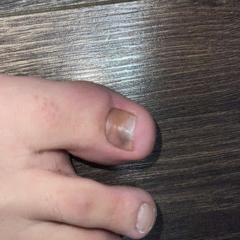 Лікування нігтів
                    Салон краси OH NAILS Одеса