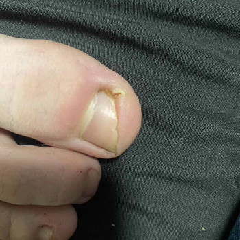 Лікування нігтів
                    Салон краси OH NAILS Одеса