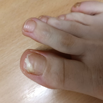 Лікування нігтів
                    Салон краси OH NAILS Одеса