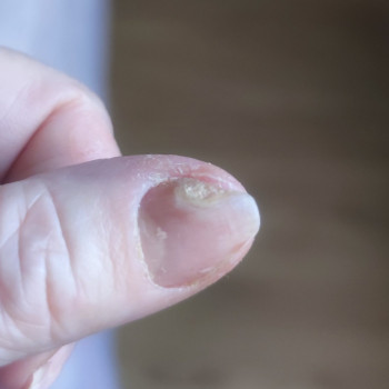 Лікування нігтів
                    Салон краси OH NAILS Одеса