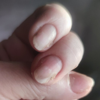 Лікування нігтів
                    Салон краси OH NAILS Одеса