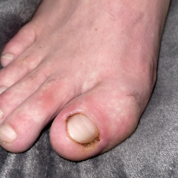 Лікування нігтів
                    Салон краси OH NAILS Одеса