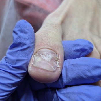 Лікування нігтів
                    Салон краси OH NAILS Одеса