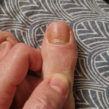 Лікування нігтів
                    Салон краси OH NAILS Одеса