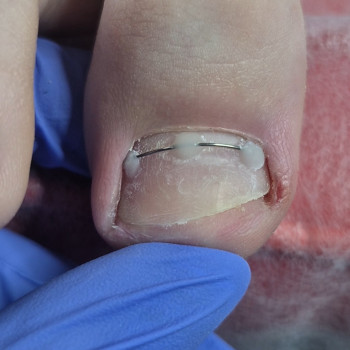 Лікування нігтів
                    Салон краси OH NAILS Одеса