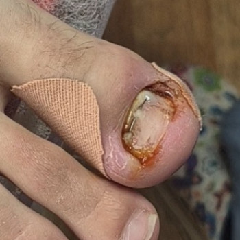 Лікування нігтів
                    Салон краси OH NAILS Одеса