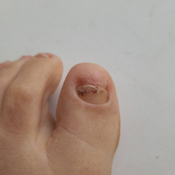 Лікування нігтів
                    Салон краси OH NAILS Одеса