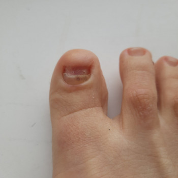 Лікування нігтів
                    Салон краси OH NAILS Одеса