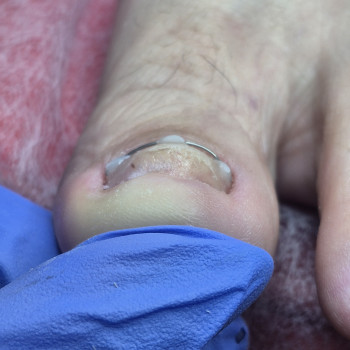 Лікування нігтів
                    Салон краси OH NAILS Одеса