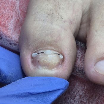 Лікування нігтів
                    Салон краси OH NAILS Одеса