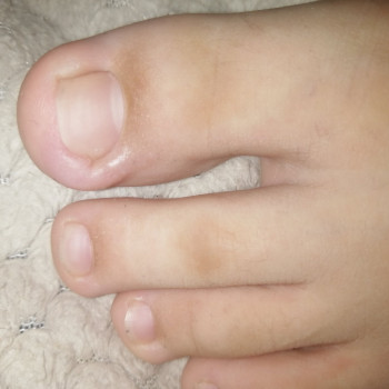 Лікування нігтів
                    Салон краси OH NAILS Одеса