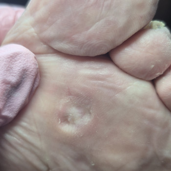 Обробка мозолі/натоптню
                    Салон красоты OH NAILS Одесса